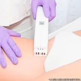 depilação laser virilha