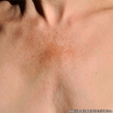 microagulhamento-microagulhamento-acne-clinica-de-microagulhamento-estrias-saude