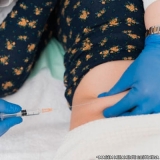 microagulhamento-microagulhamento-acne-clinica-de-microagulhamento-para-estrias-aeroporto