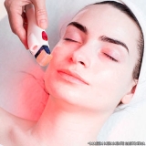 Microagulhamento Facial