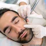 Microagulhamento para Acne