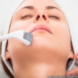 microagulhamento-microagulhamento-acne-clinica-de-microagulhamento-no-rosto-moema