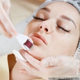microagulhamento-microagulhamento-acne-clinica-de-microagulhamento-para-estrias-moema
